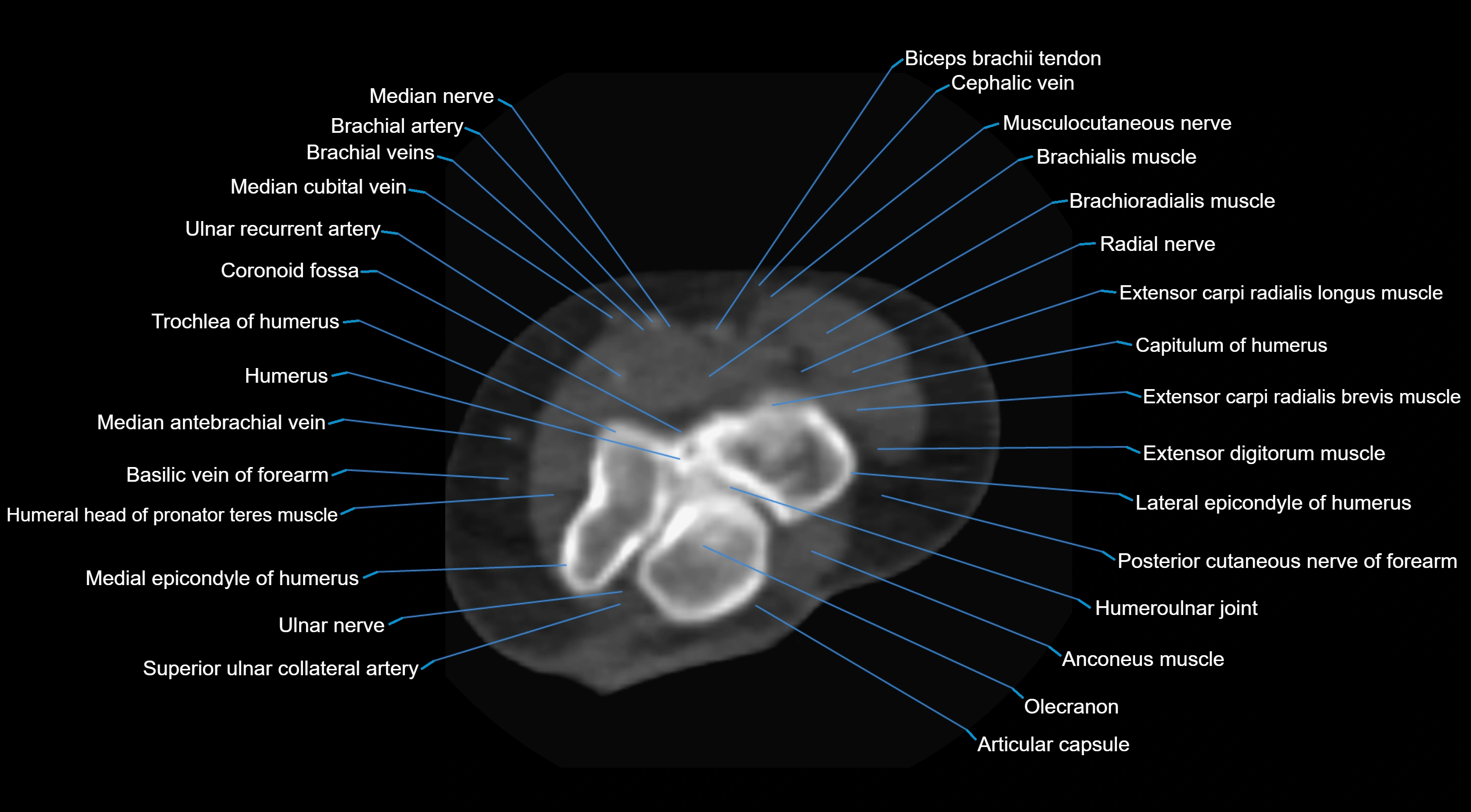 CT elbow axial  cross sectional anatomy labelled  radiology image -00020.webp